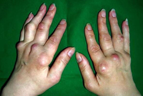 Руки, пораженные деформирующим остеоартрозом